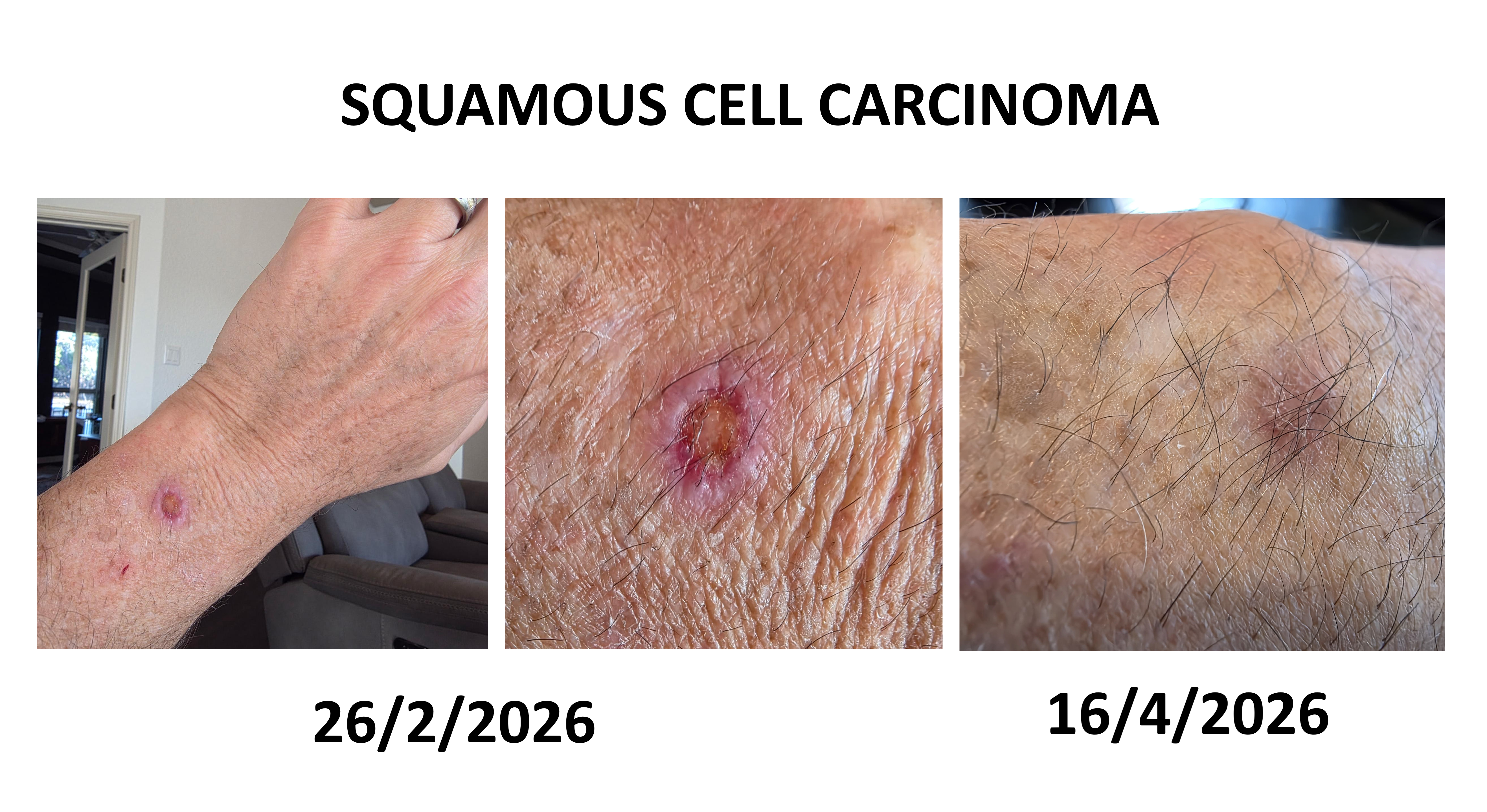 Squamous cell carcinoma treated with homeopathy